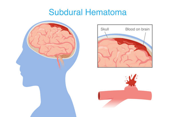 神經干細胞移植治療腦出血的系統評價:NSC來源、輸送途徑、治療機制和早期臨床試驗 神經干細胞移植治療腦出血的系統評價:NSC來源、輸送途徑、治療機制和早期臨床試驗
